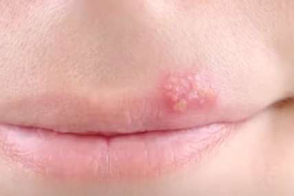 ČESTA REAKCIJA ORGANIZMA Herpes na usni može biti znak da ste pod stresom