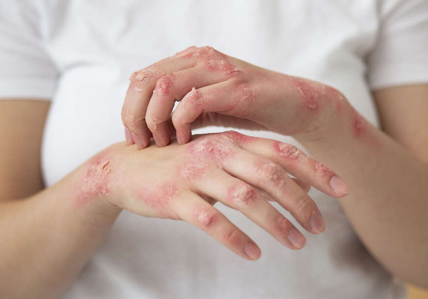 ZDRAVLJE NA USTA ULAZI Ako vas muči psorijaza određene namirnice mogu biti od pomoći